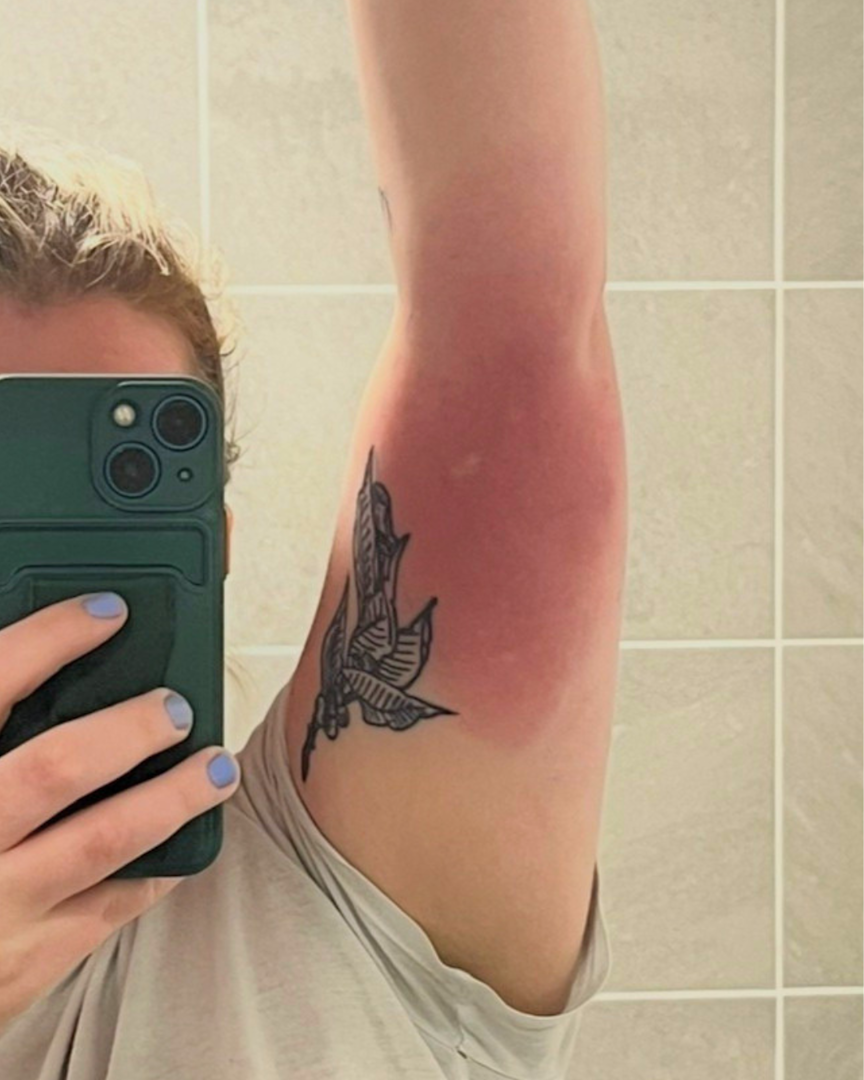 Skeeter syndrome on an arm
